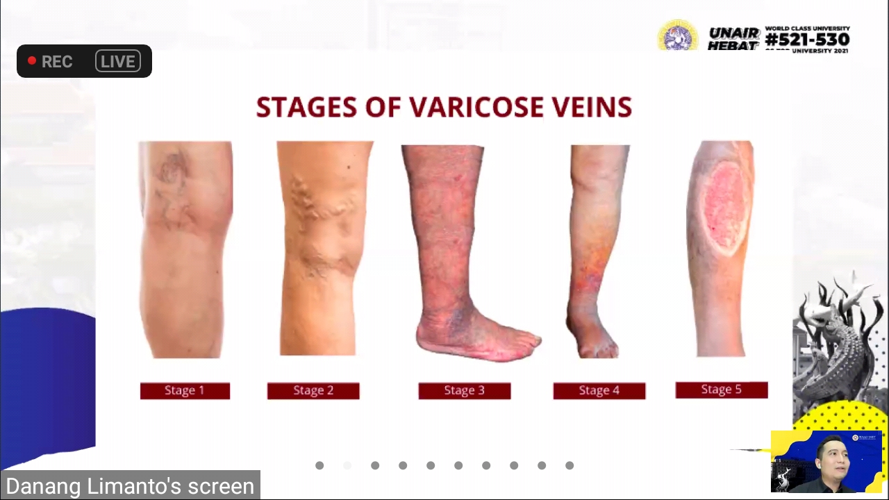 Severity of varicose veins and their treatments